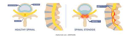 “Comprehensive Physiotherapy for Lumbar Stenosis: A Gentle Path to Relief”