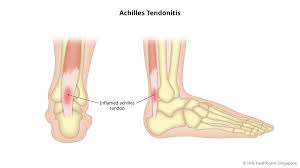 Achilles Tendinopathy – Caring for Your Achilles Tendon