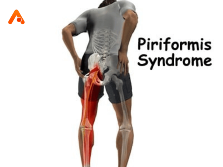 Piriformis Syndrome :