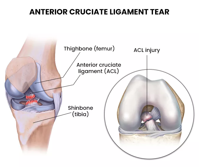 Ligament Tear ACL