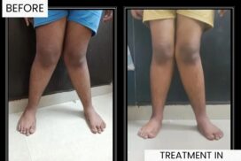 kids knock knees treatment