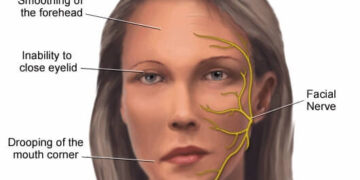 Bell’s/Facial Palsy