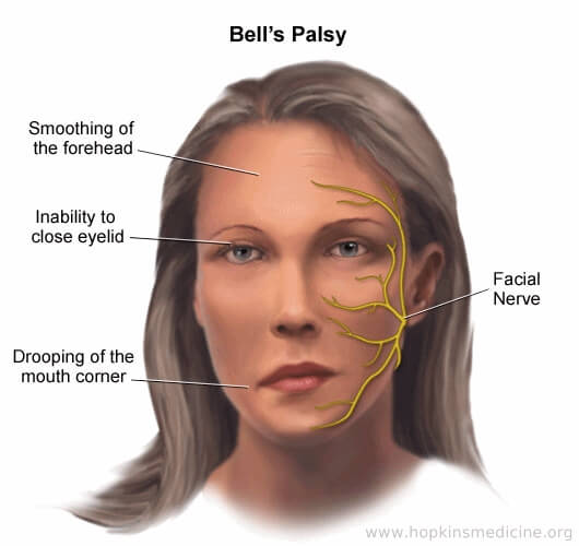 Bell’s/Facial Palsy