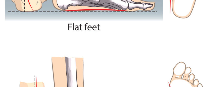 Flat Foot