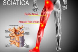 sciatica pain management