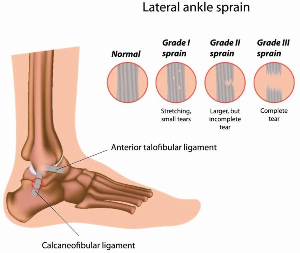 Ankle ligament: Best Physiotherapist in India