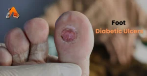 Physiotherapy Management of Diabetic Ulcers