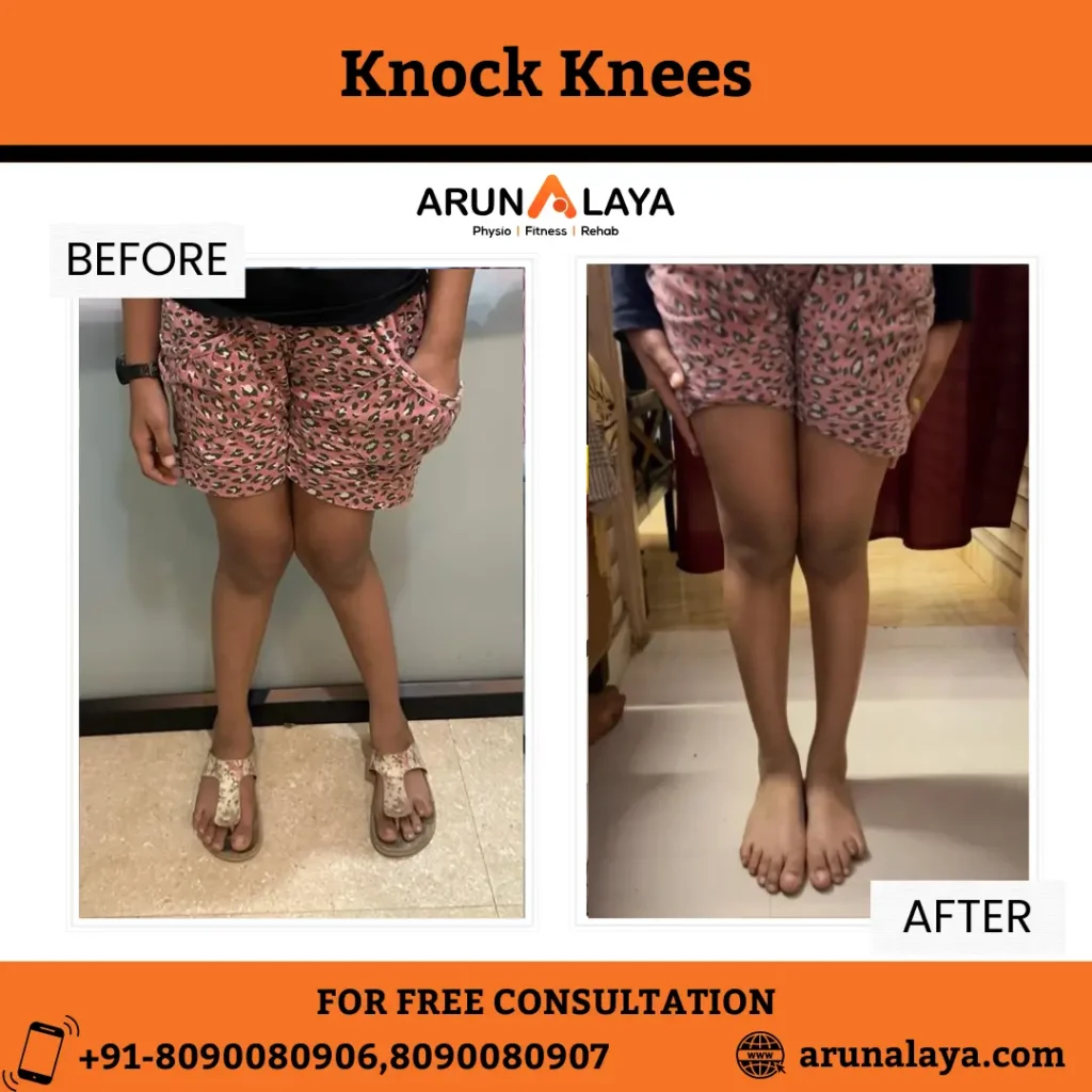 knock knees before and after results