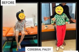 child cerebral palsy before and after