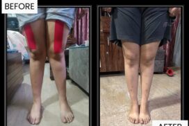 genu valgum treatment