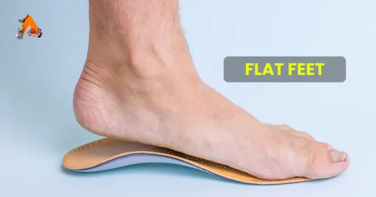 Flat Feet: Causes, Classification, and Impact