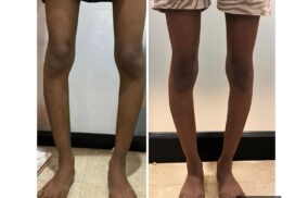 bow leg success story