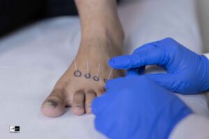 foot drop treatment and cure dry needling