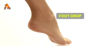 Foot Drop: Causes, Symptoms, and Physiotherapy Treatments