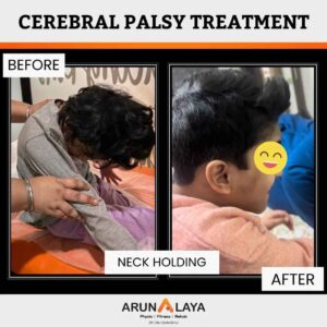 Child cerebral palsy treatment results