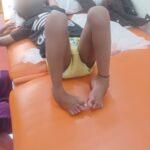 clubfoot treatment