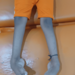 clubfoot treatment without surgery