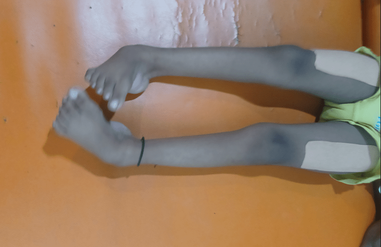 clubfoot treatment and cure