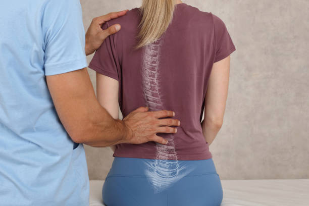 Idiopathic Scoliosis