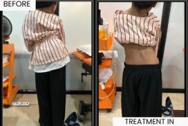 child scoliosis treatment result