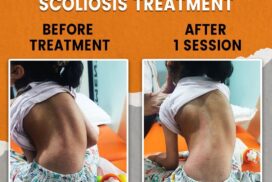 child scoliosis treatment in Delhi