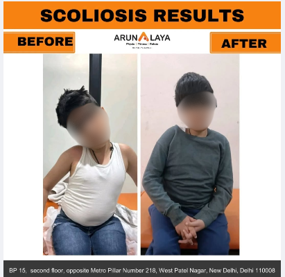 child scoliosis treatment and cure