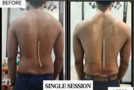 adult scoliosis treatment result